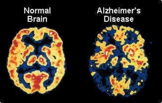 Could Walking Upstairs Prevent Alzheimers?